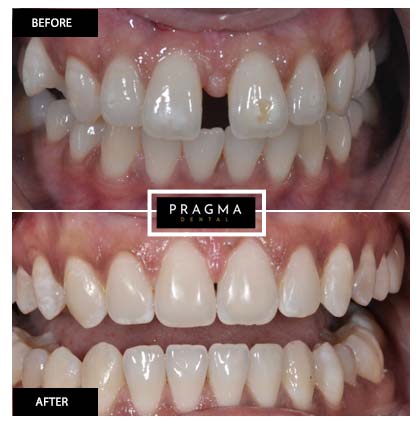 Before & After Cosmetic Tooth Bonding Smile Makeover