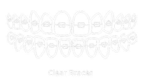 Clear Braces (Six Month Smiles) Illustration