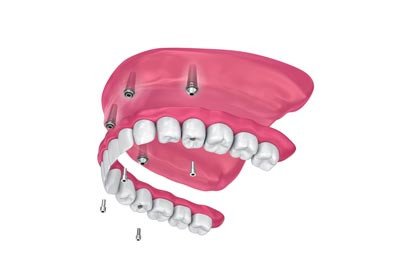 Implant Dentures