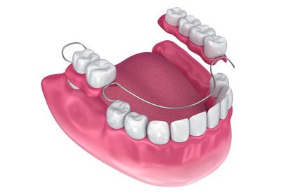 Removable - Partial Dentures